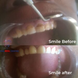 teeth whitening before and after 3