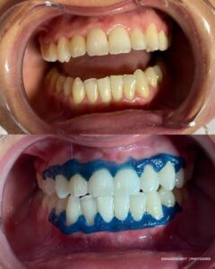 teeth whitening before and after kdc